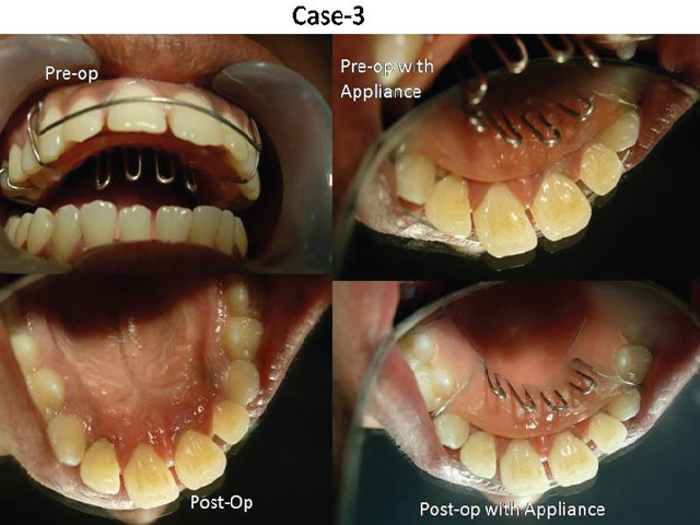 Case No.3- Pre-op photo and Post-op photos after Non-surgical Periodontal Therapy