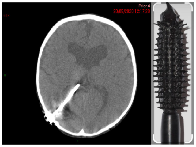 (Left) Mascara Sign observed on CT image analysed on Carestream Vue PACS corrected with 3D MPR to show lumen of proximal catheter;