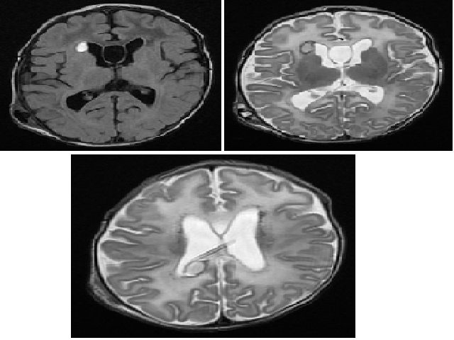 Axial and sagittal sections demonstrating periventricular haemorrhagic lesions.