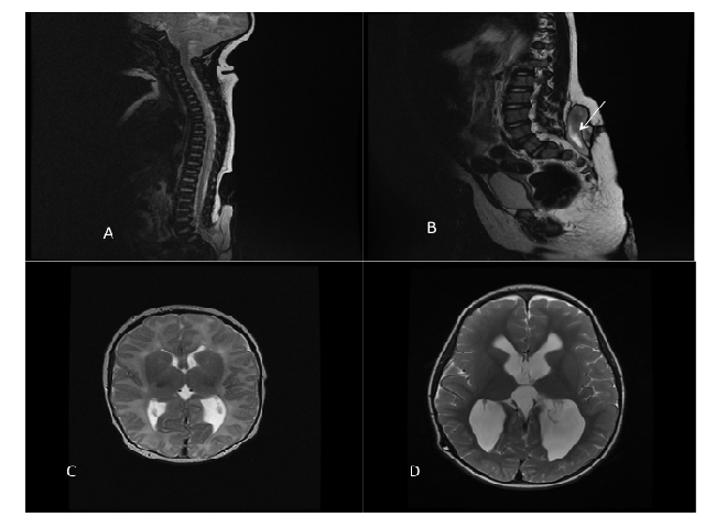 A-B. MRI spine before (a) and at presentation (b)- note obvious increased size of pseudomeningocele. C-D. Comparison of previous MRI Brain (c) and MRI prior to shunt revision (d)