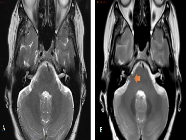 A. Axial MRI brain scan of patient at level of Internal Auditory Meatus (IAM). B. Right IAM prior to primary procedure.